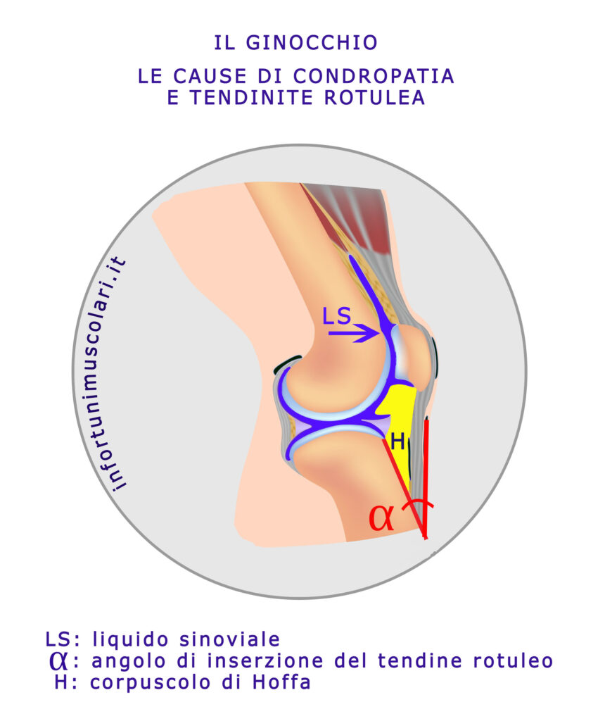 L'importanza dell'angolo di inserzione del tendine rotuleo