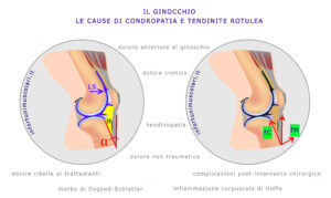 Il dolore al ginocchio, tendinopatia e condropatia